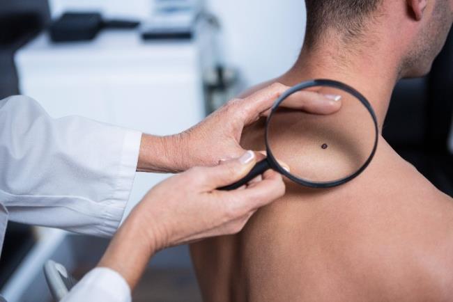 בדיקת שומות עם חשד עקב חשד לסרטן העור מסוג מלנומה בגבר צעיר